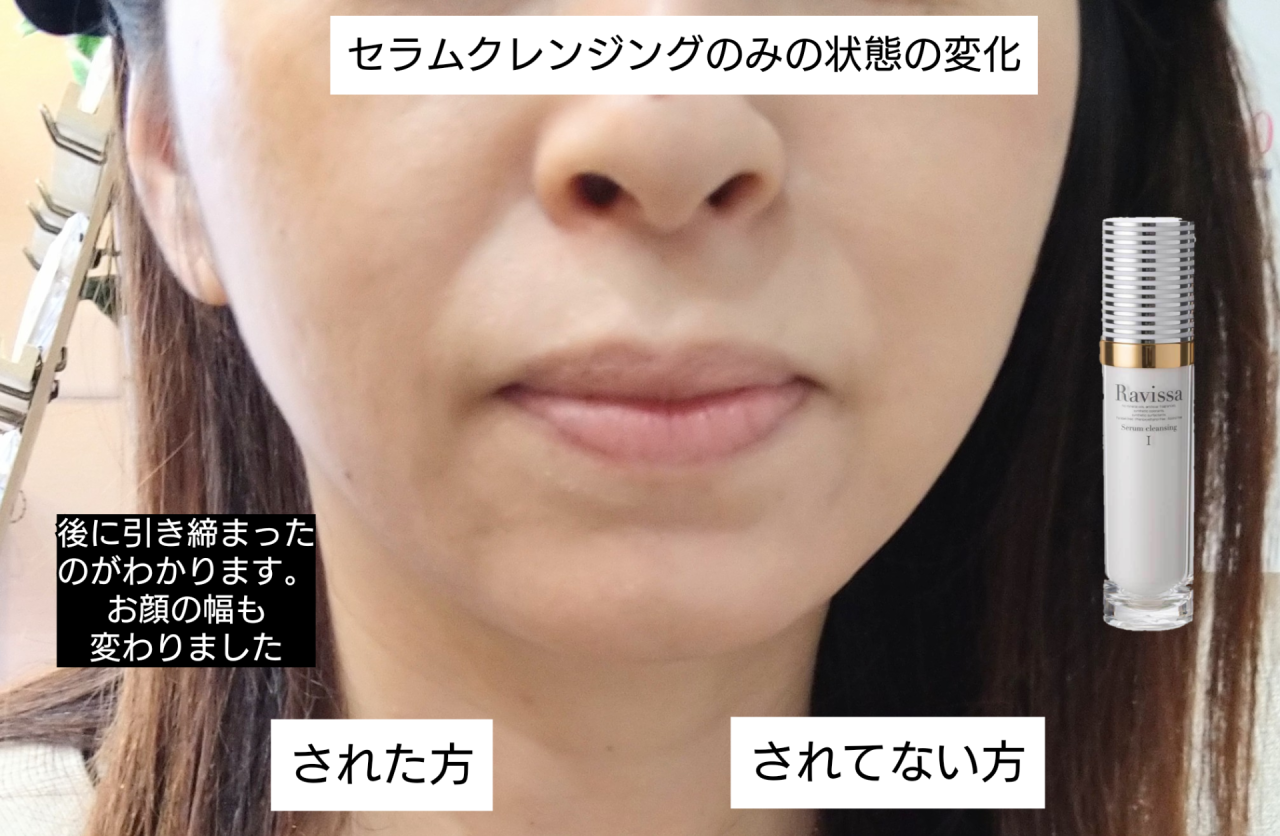 セラムクレンジングでお顔の輪郭が変わり引き締まったフェイスラインに！